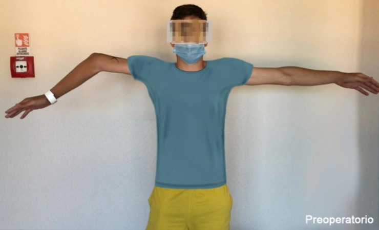 Si era fratturato il gomito da bambino, ora sta guarendo così