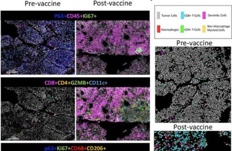 tumore metastasi regressione vaccino covid-19 